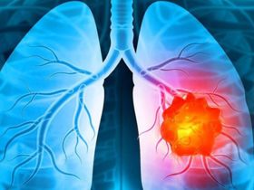 GIẢI ĐÁP: Điều trị ung thư phổi như thế nào?